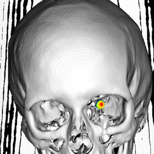 Optikusmeningeom 3D-Ga68-DOTATOC-PET/CT Optikusmeningeom 3D-Ga68-DOTATOC-PET/CT