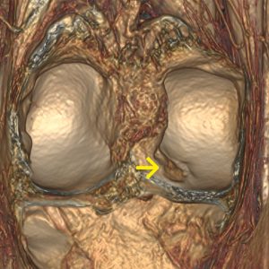 Osteochondrosis dissecans Zufallsbefund MRT