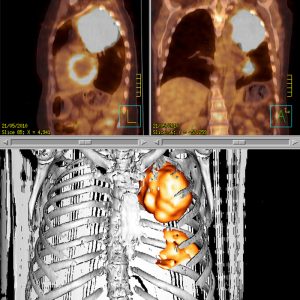 Pancoast Tumor des Sulcus superior li FDG-PET/CT