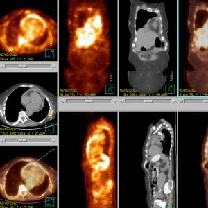 Perikarditis FDG-PET/CT