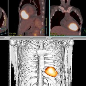 Perikardmetastase Cervix Ca FDG-PET/CT