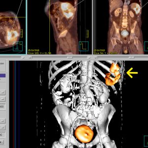 Perilienaler Milzabszess FDG-PET/CT