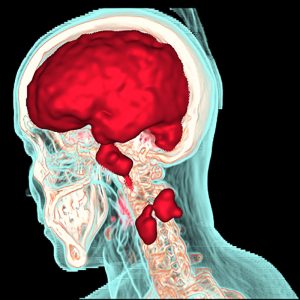 Pharynxkarzinom FDG-PET/CT