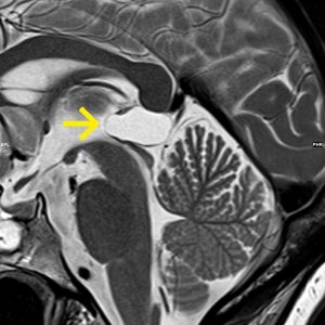 Pinealiszyste kein Parinaud-Syndrom sagT2-MRT Pinealiszyste kein Parinaud-Syndrom sagT2-MRT