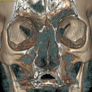Polyposis nasi CT-NNH