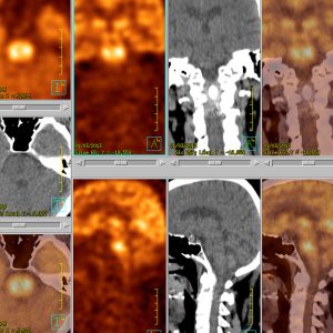 Ponsgliom FDG-PET/CT