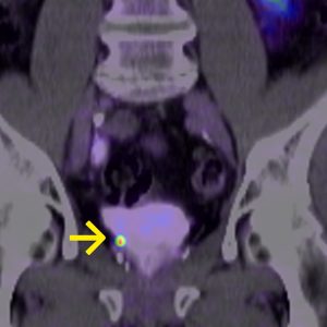 Prostatakarzinom Lokalrezidiv bei Kapseldurchbruch F18-PSMA-PET/CT Prostatakarzinom Lokalrezidiv bei Kapseldurchbruch F18-PSMA-PET/CT