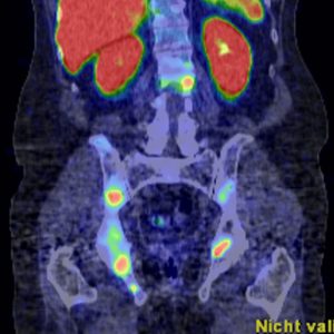Prostatakarzinom Skelettmetastasen F18-PSMA-PET/CT