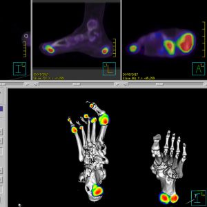 Psoriasisarthritis Fuss F18-Fluorid-PET/CT