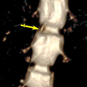 Recessusstenose L2 3 re u medialer BSV L1 2 MR-Myelo