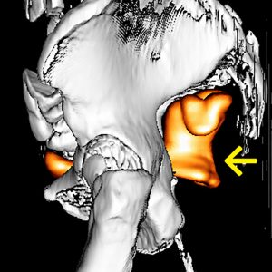 Rektumkarzinom FDG-PET/CT-VR Rektumkarzinom FDG-PET/CT-VR