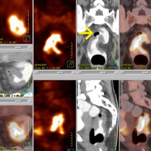 Rektumkarzinom FDG-PET/CT mit rektaler Fülllung Rektumkarzinom FDG-PET/CT mit rektaler Fülllung