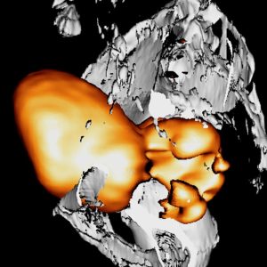 Rektumkarzinom mit Abzess FDG-PET/CT
