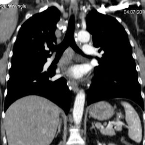 Sarkoidose Lungenbefall bihiläre Adenopathie-CT