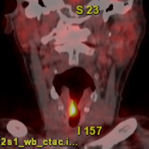Stimmlippenkrebs rechts FDG-PET/CT Stimmlippenkrebs rechts FDG-PET/CT
