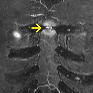 Synchondritis sterni MRT-STIR-cor