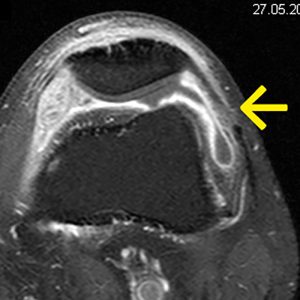 Synovialitis Knie MRT-axiale-T1-mit-KM