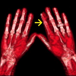 Tendovaginitis Beugesehne li Zeigefinger FDG-PET/CT