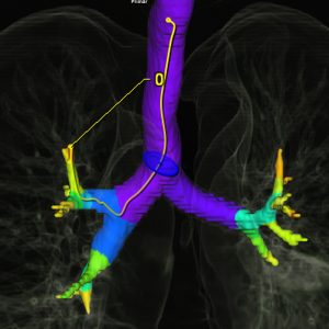 Trachealbaum low-dose-CT