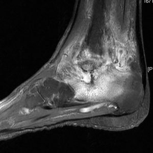 Tuberkuloese Arthritis des Sprunggelenkes MRT