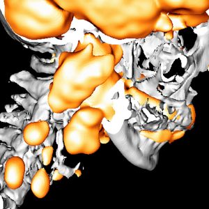 Zungengrundkarzinom cervikale Lymphknotenmetastasen FDG-PET/CT